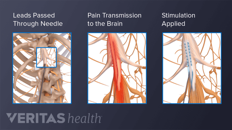 The insertion of spinal cord stimulator leads through a needle into the epidural space, transmission of pain signals in the spine, and application of neurostimulation.