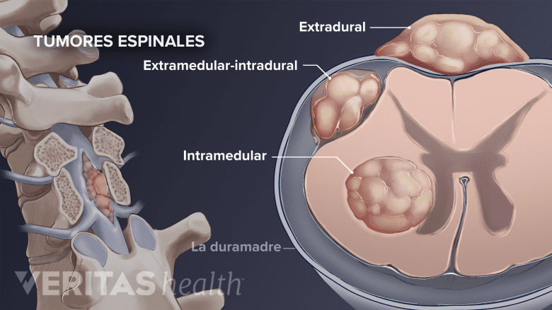 Tumores en diferentes partes de la columna vertebral.