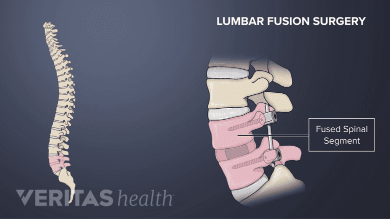 Illustration showing lumbar spinal fusion segment.