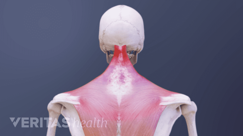 3D image of damaged neck muscles.