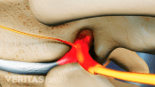Herniated disc pinching a nerve between two vertebrae.