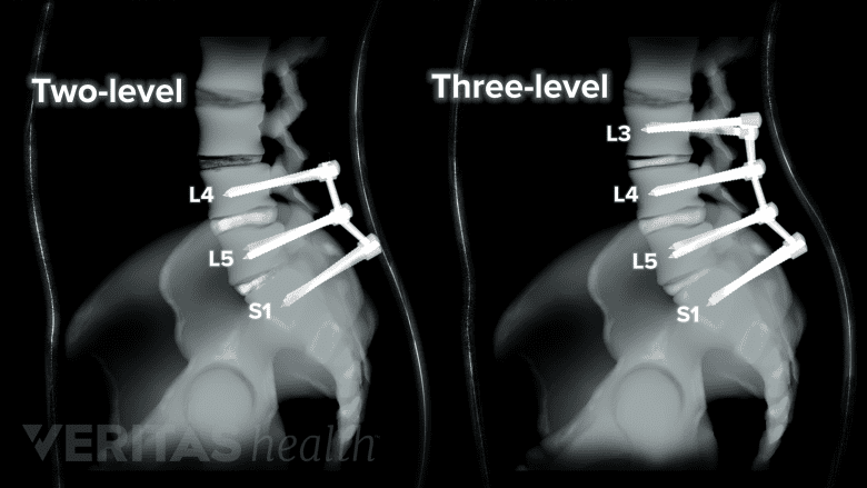 xray of a two and three level spinal fusion