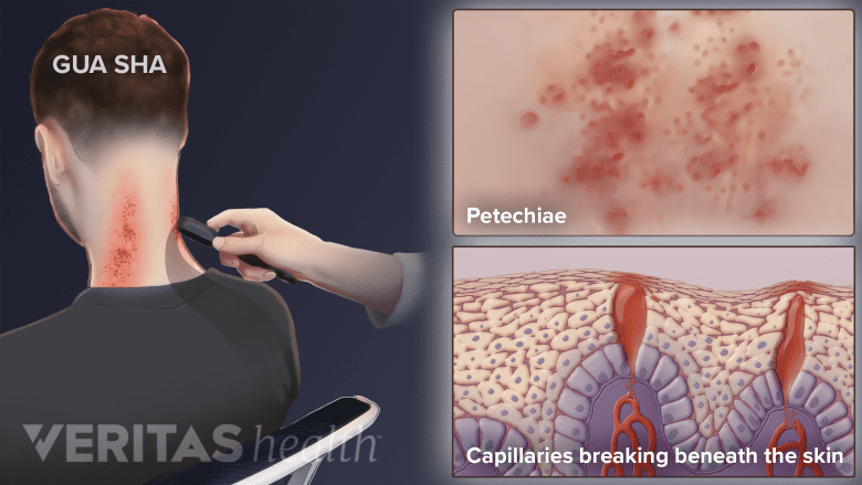 Gua Sha showing petechiae and capillaries breaking beneath the skin