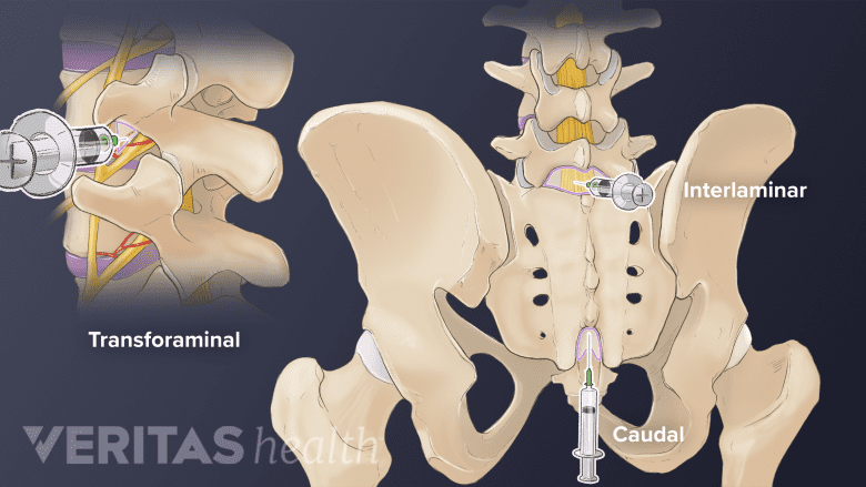 Epidural injection within the spine