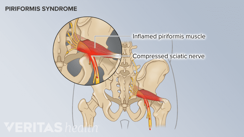 Illustration of the pelvic bone, focused on the piriformis muscle and sciatic nerve.