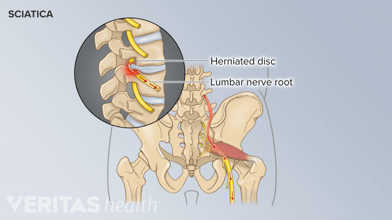 A herniated disc pressing the lumbar nerve root and causing sciatica pain.