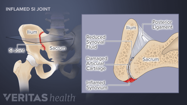 Degeneration of the SI joint.