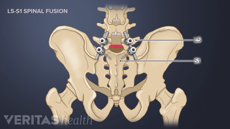 Pedicle screws and rods being used in a spinal fusion of L5 AND S1 segment.