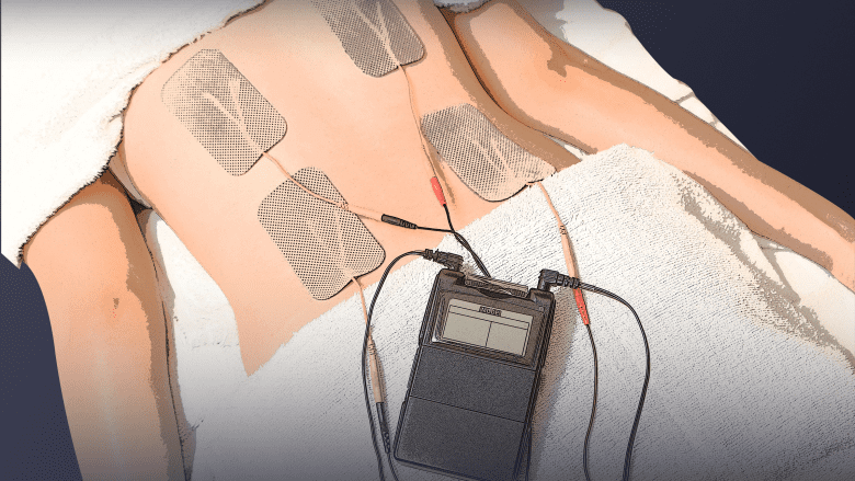 an image showing electrodes of TENs on back muscle.