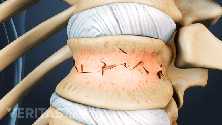 Illustration showing fractured vertebral spine.