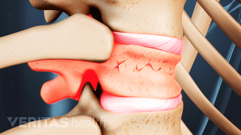 Illustration showing vertebral fracture highlighted in red.
