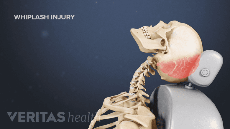 Illustration showing whiplash injury.